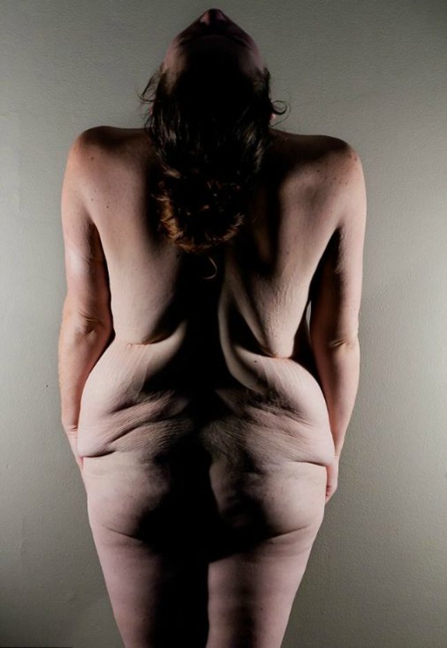 Похудевшая на 72 кг женщина ужаснула обнаженным телом (фото)