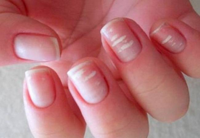 Медики объяснили, о чем свидетельствуют белые пятна на ногтях