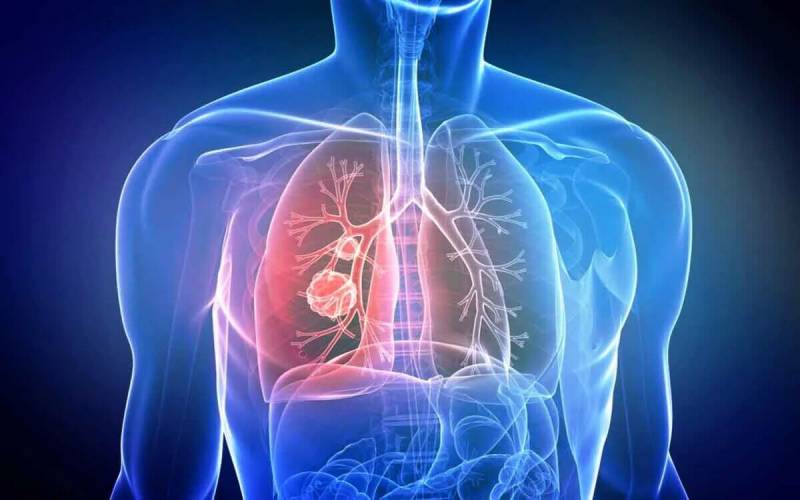 Онкологи назвали новий незвичайний симптом раку легенів