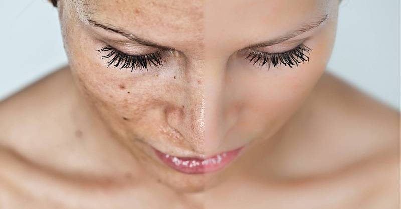 Косметологи розповіли, які продукти допоможуть прибрати пігментні плями з обличчя